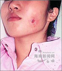 微整形顾客酒窝做深了让我赔钱我该怎么办?请