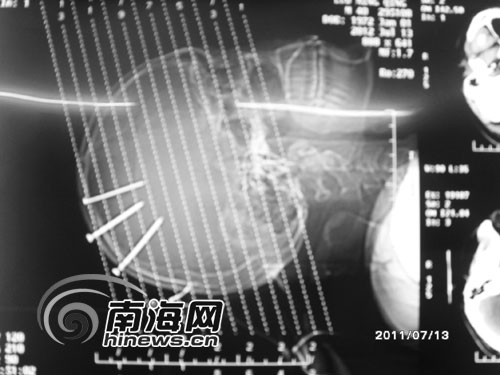 三亚男子将4根铁钉插进头部 称我老婆要杀我