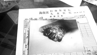 小名诊断为麦克尔憩室,肠梗阻伴粘连,支气管肺炎