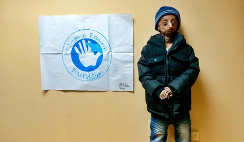 未老先衰:印度14岁男孩患早衰症 体重仅为25斤