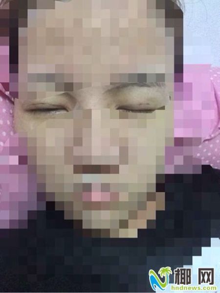 爱美少女割双眼皮整成 熊猫眼 ?医院回应