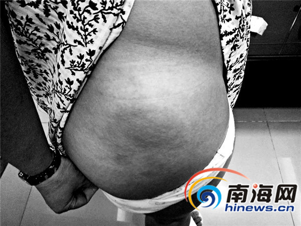 2名备孕女子海南和京医院打黄体酮打出硬块(图