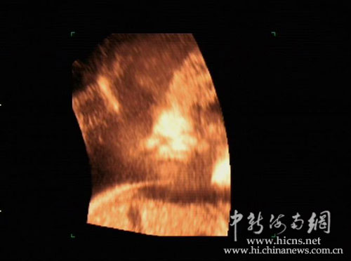 据了解,春节前后这半个月,该院通过四维彩超已连续查出3例畸形胎儿,另