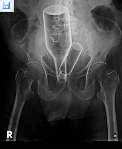 人工肛门_人工肛门袋